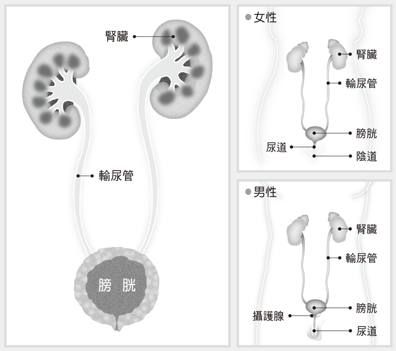 膀胱癌