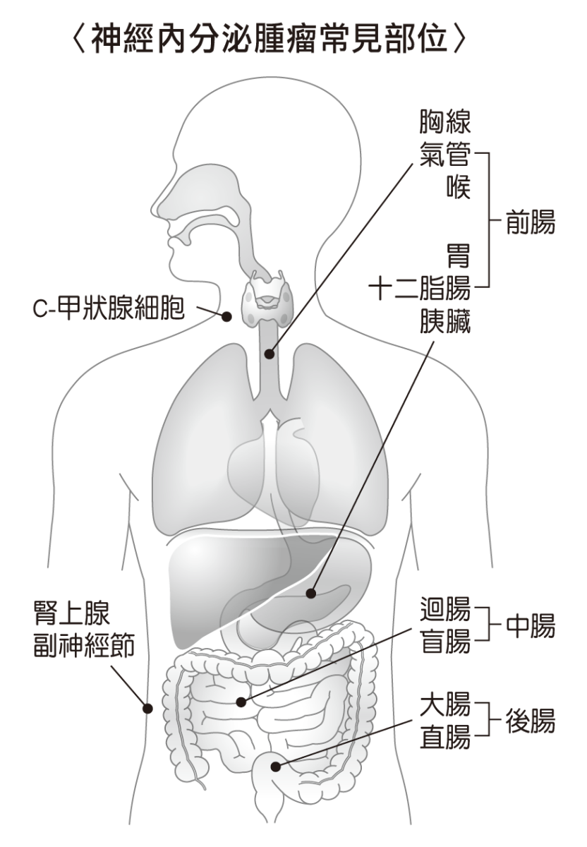 神經內分泌腫瘤